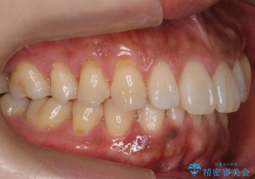 『前歯のすき間を短期間で治したい』インビザライン(枚数制限あり)症例の治療後