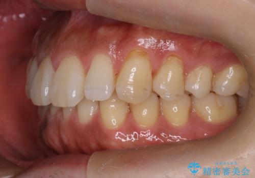『前歯のすき間を短期間で治したい』インビザライン(枚数制限あり)症例の治療後