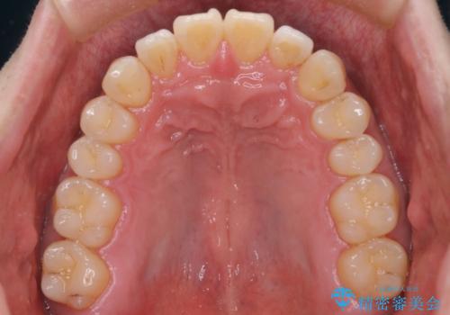 『前歯のすき間を短期間で治したい』インビザライン(枚数制限あり)症例の治療後