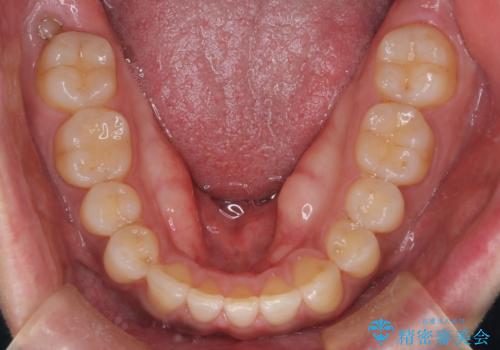 『前歯のすき間を短期間で治したい』インビザライン(枚数制限あり)症例の治療後