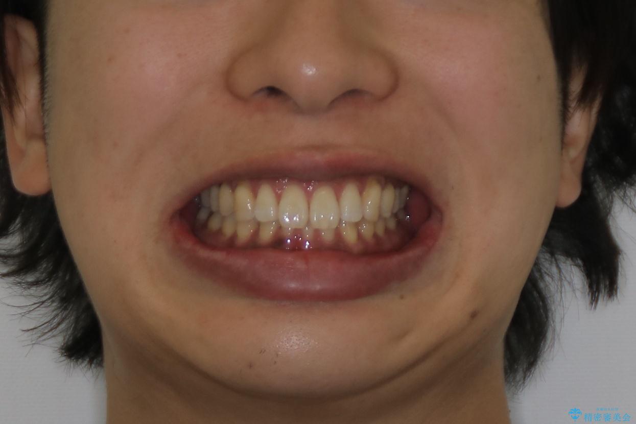 『前歯のすき間を短期間で治したい』インビザライン(枚数制限あり)症例の治療後（顔貌）