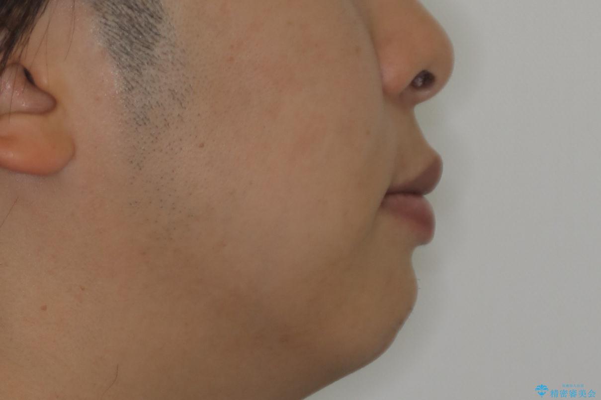 『前歯のすき間を短期間で治したい』インビザライン(枚数制限あり)症例の治療後(顔貌)