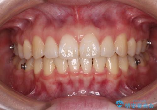 【モニター】すきっ歯をインビザラインで解消の治療中