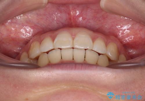 【モニター】すきっ歯をインビザラインで解消の治療中