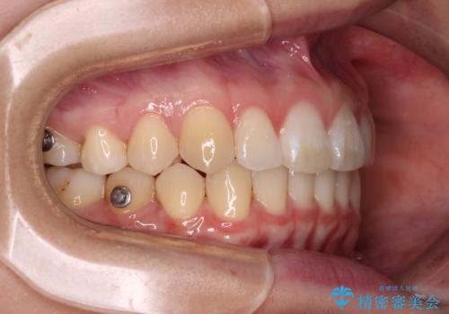 【モニター】すきっ歯をインビザラインで解消の治療中