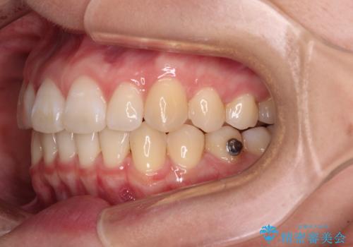 【モニター】すきっ歯をインビザラインで解消の治療中