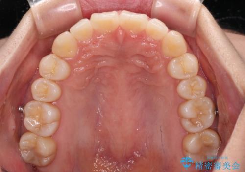 【モニター】すきっ歯をインビザラインで解消の治療中