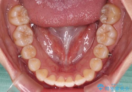 【モニター】すきっ歯をインビザラインで解消の治療中