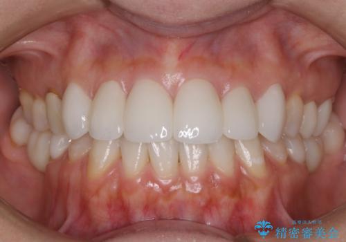 被せ物で見た目が変わる　前歯のセラミッククラウンの症例 治療後