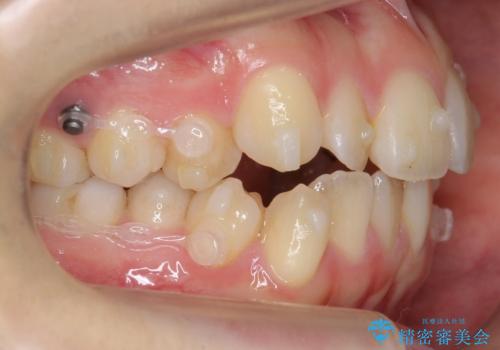 下の八重歯　歯を抜かずに　インビザライン治療の治療中