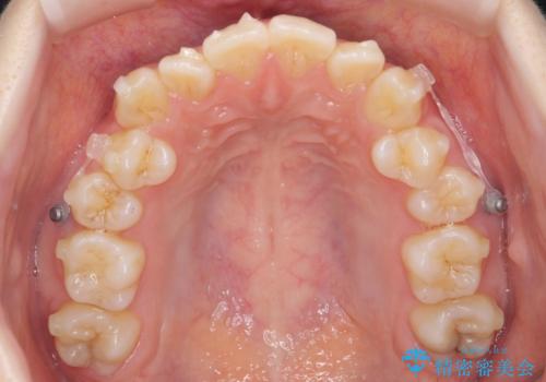 下の八重歯　歯を抜かずに　インビザライン治療の治療中