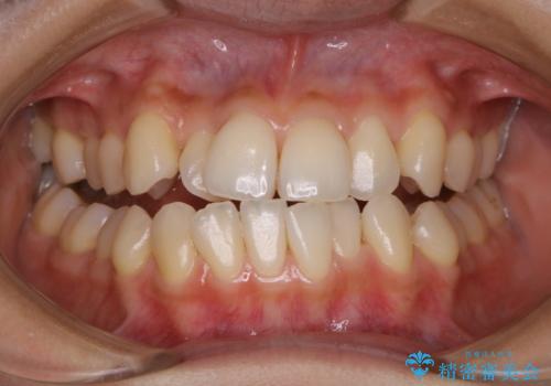 矯正スタート前に全体のクリーニング(PMTC)の症例 治療後