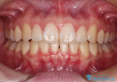 【モニター】すきっ歯をインビザラインで解消の症例 治療後