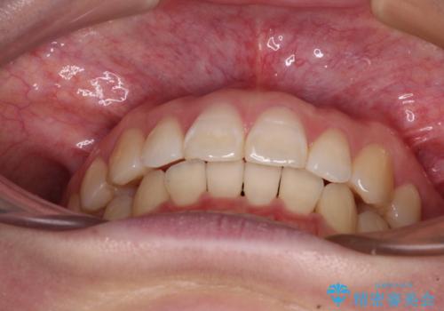 【モニター】すきっ歯をインビザラインで解消の治療後