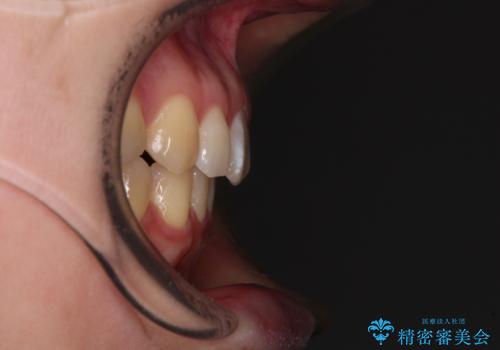 【モニター】すきっ歯をインビザラインで解消の治療後