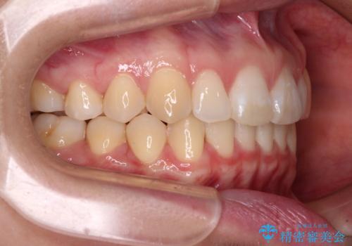 【モニター】すきっ歯をインビザラインで解消の治療後