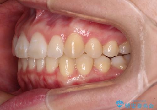 【モニター】すきっ歯をインビザラインで解消の治療後