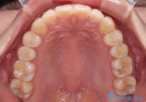 【モニター】すきっ歯をインビザラインで解消の治療後