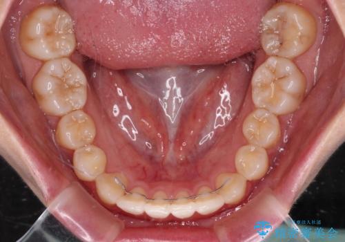 【モニター】すきっ歯をインビザラインで解消の治療後