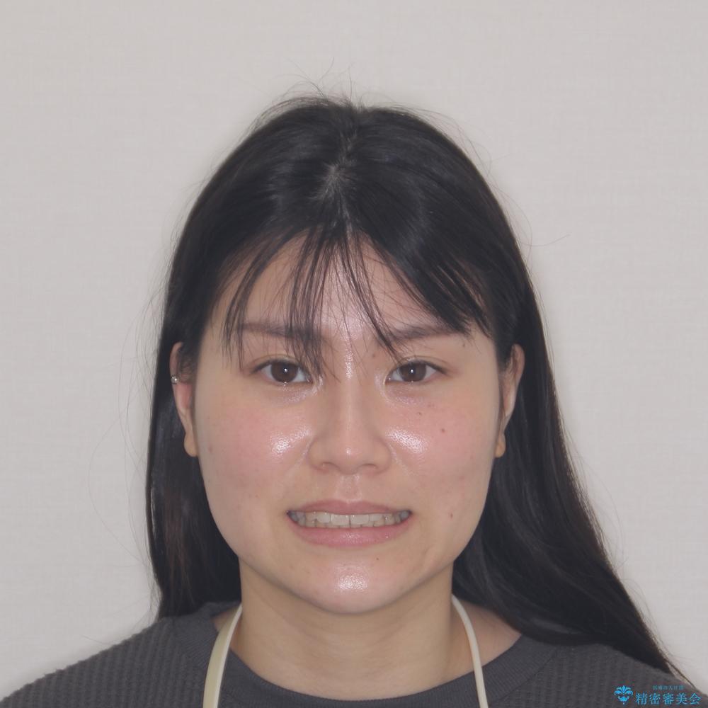 【モニター】すきっ歯をインビザラインで解消の治療後(顔貌)