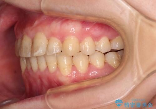 前歯のデコボコと奥歯のクロスバイト　インビザラインで改善の治療中