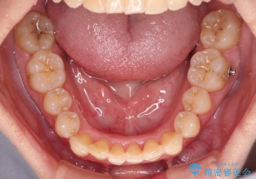 前歯のデコボコと奥歯のクロスバイト　インビザラインで改善の治療中