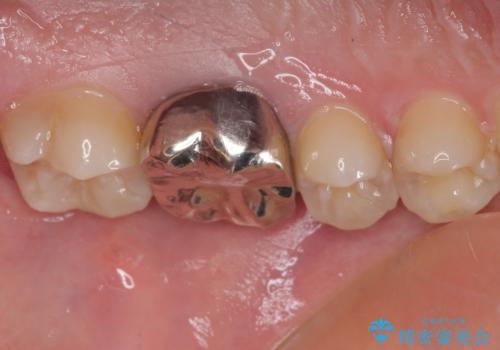 目立つ銀歯を白くしたい セラミック治療の治療前