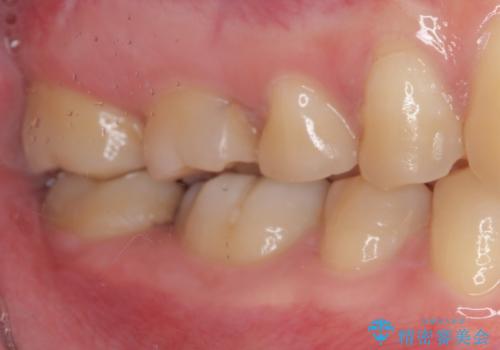 目立つ銀歯を白くしたい セラミック治療の治療前