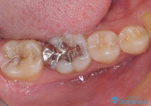 目立つ銀歯を白くしたい セラミック治療の治療前