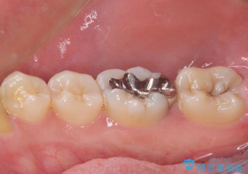 目立つ銀歯を白くしたい セラミック治療の治療前