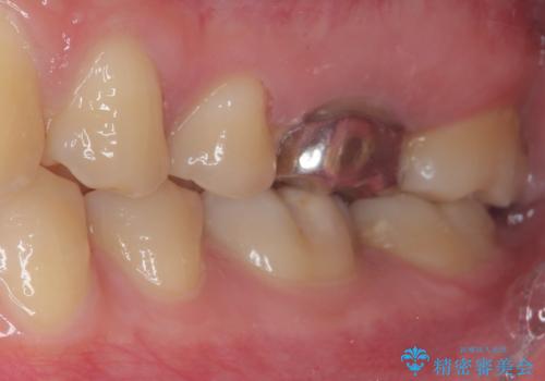 目立つ銀歯を白くしたい セラミック治療の治療前