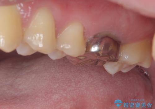 目立つ銀歯を白くしたい セラミック治療の治療前