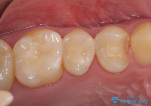 詰め物が外れた セラミックインレー修復の治療前