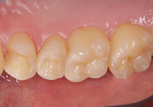 詰め物が外れた セラミックインレー修復の治療前