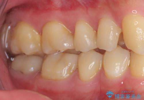 詰め物が外れた セラミックインレー修復の治療前