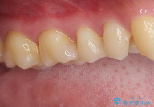 詰め物が外れた セラミックインレー修復の治療前