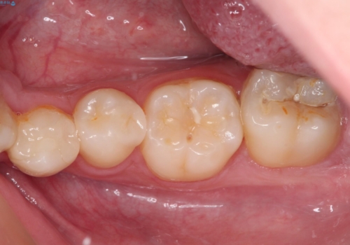 詰め物が欠けた セラミックインレーによる修復の治療後