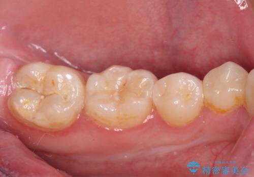 詰め物が欠けた セラミックインレーによる修復の治療後