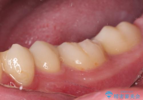 詰め物が欠けた セラミックインレーによる修復の治療後