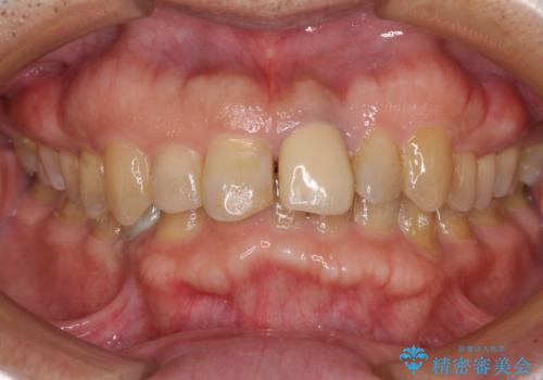 欠損歯列の矯正治療とインプラント治療の治療中