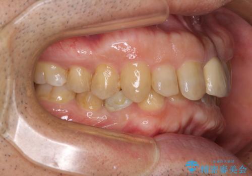 欠損歯列の矯正治療とインプラント治療の治療中
