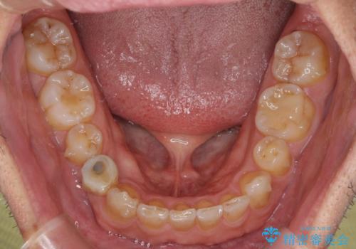 欠損歯列の矯正治療とインプラント治療の治療中