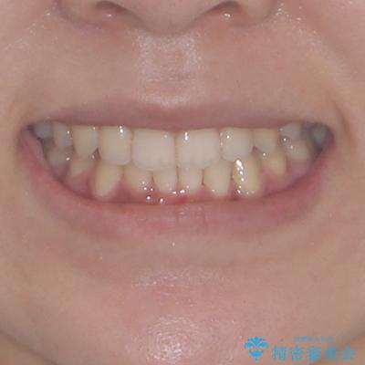著しい八重歯が気になる　インビザラインでの矯正治療の治療後（顔貌）