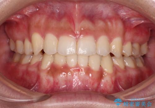 著しい八重歯が気になる　インビザラインでの矯正治療の症例 治療後
