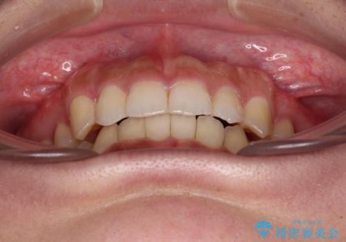 著しい八重歯が気になる インビザラインでの矯正治療の治療後