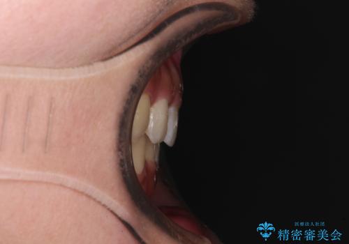 著しい八重歯が気になる インビザラインでの矯正治療の治療後