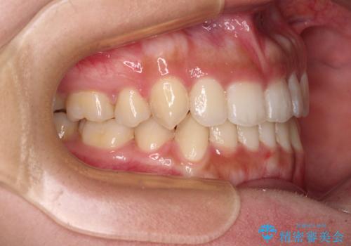 著しい八重歯が気になる インビザラインでの矯正治療の治療後