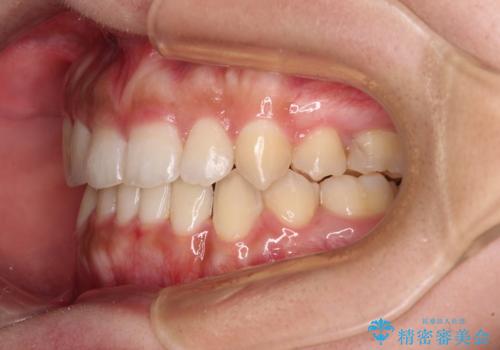 著しい八重歯が気になる　インビザラインでの矯正治療の治療後