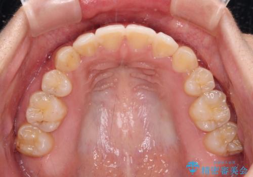 著しい八重歯が気になる インビザラインでの矯正治療の治療後