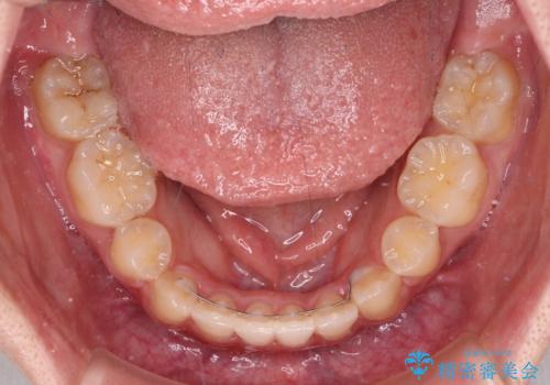 著しい八重歯が気になる インビザラインでの矯正治療の治療後